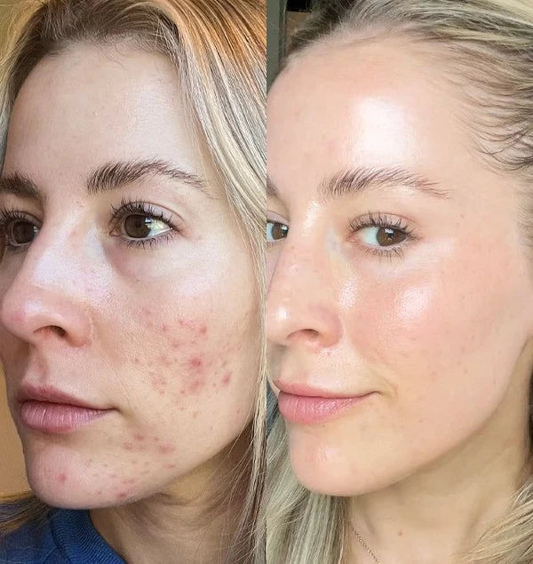 I haven't touched foundation in weeks. My skin feels bright, balanced, and finally mine.