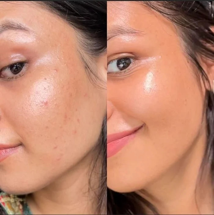 Fewer breakouts, smooth texture, no redness. I feel confident showing up exactly as I am.